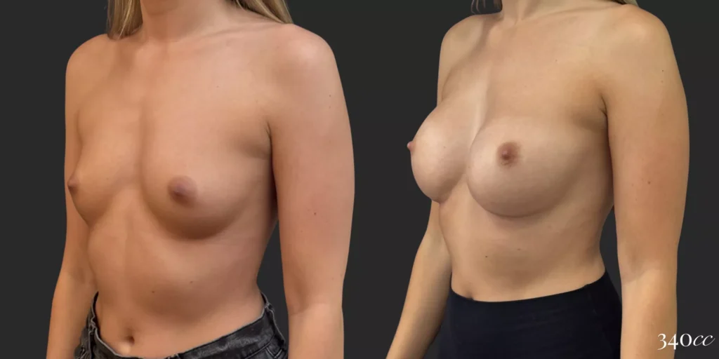 Breast Augmentation #032, before and after photo, view 2