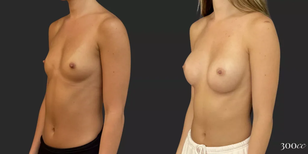 Breast Augmentation #035, before and after photo, view 2