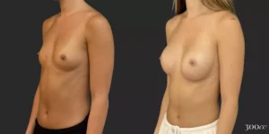 Breast Augmentation #035, before and after photo, view 2