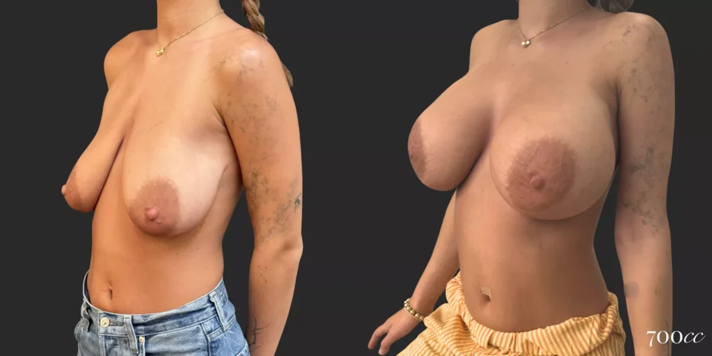 Breast Augmentation #036, before and after photo, view 2