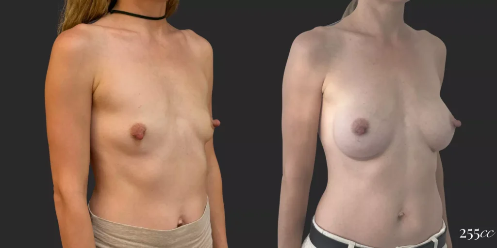 Breast Augmentation #038, before and after photo, view 2