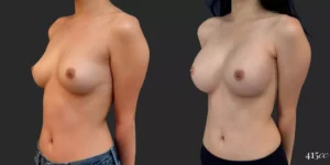 Breast Augmentation #039, before and after photo, view 2