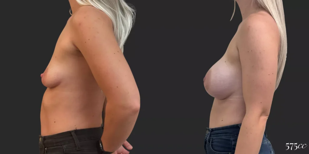 Breast Augmentation #041, before and after photo, view 2