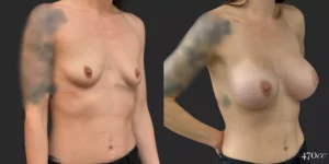 Breast Augmentation #042, before and after photo, view 2