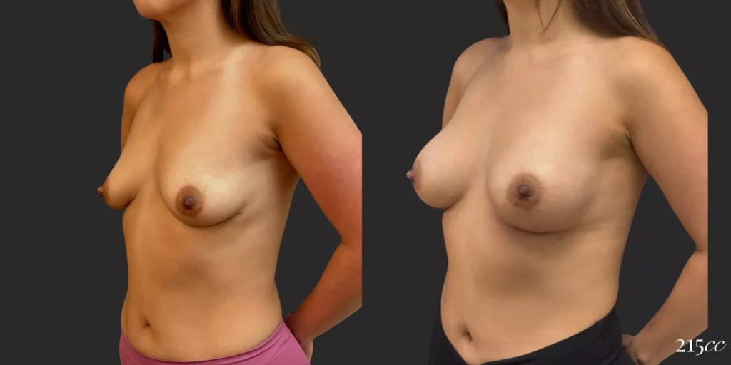 Breast Augmentation #044, before and after photo, view 2