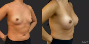Breast Augmentation #045, before and after photo, view 2