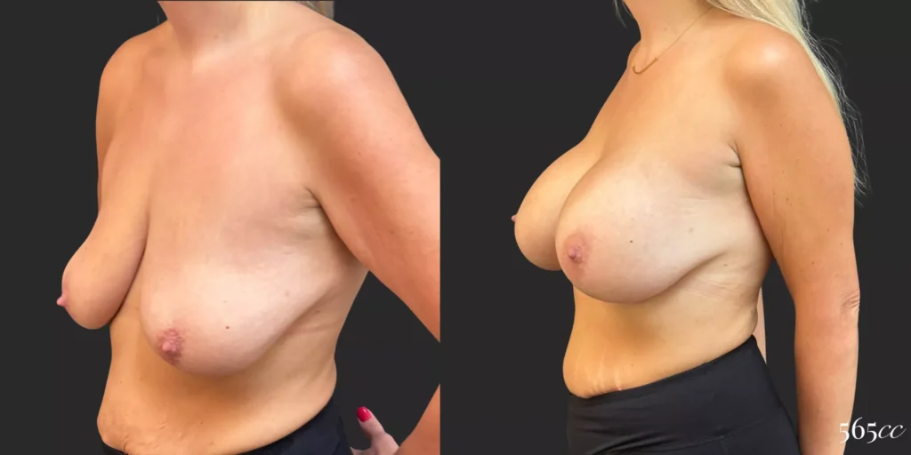 Breast Augmentation #046, before and after photo, view 2