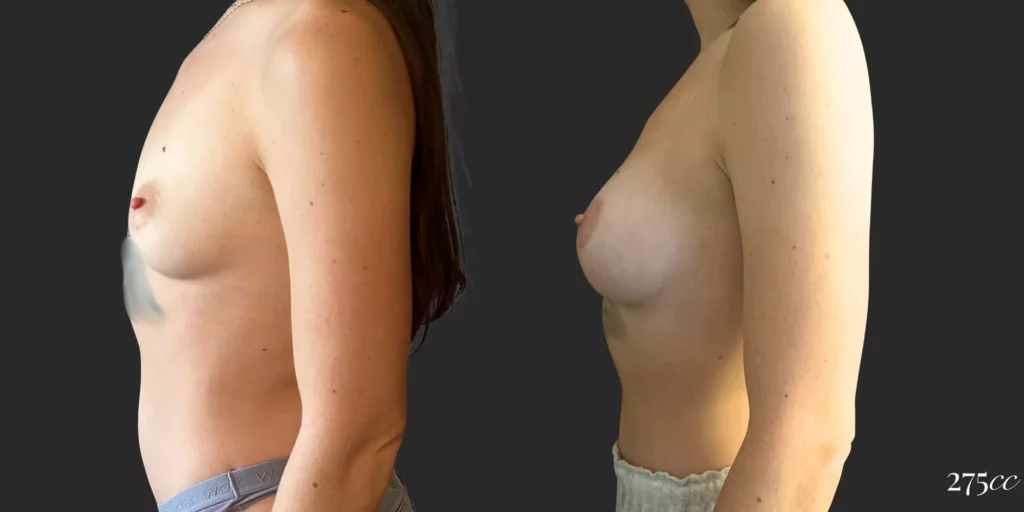 Breast Augmentation #048, before and after photo, view 2