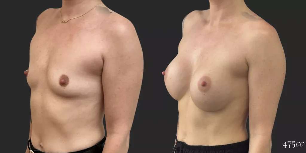 Breast Augmentation #049, before and after photo, view 2