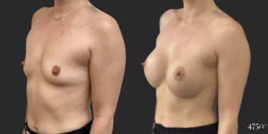 Breast Augmentation #049, before and after photo, view 2
