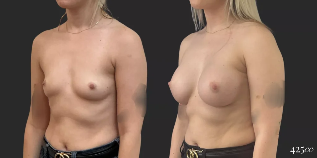 Breast Augmentation #050, before and after photo, view 2