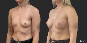 Breast Augmentation #050, before and after photo, view 2