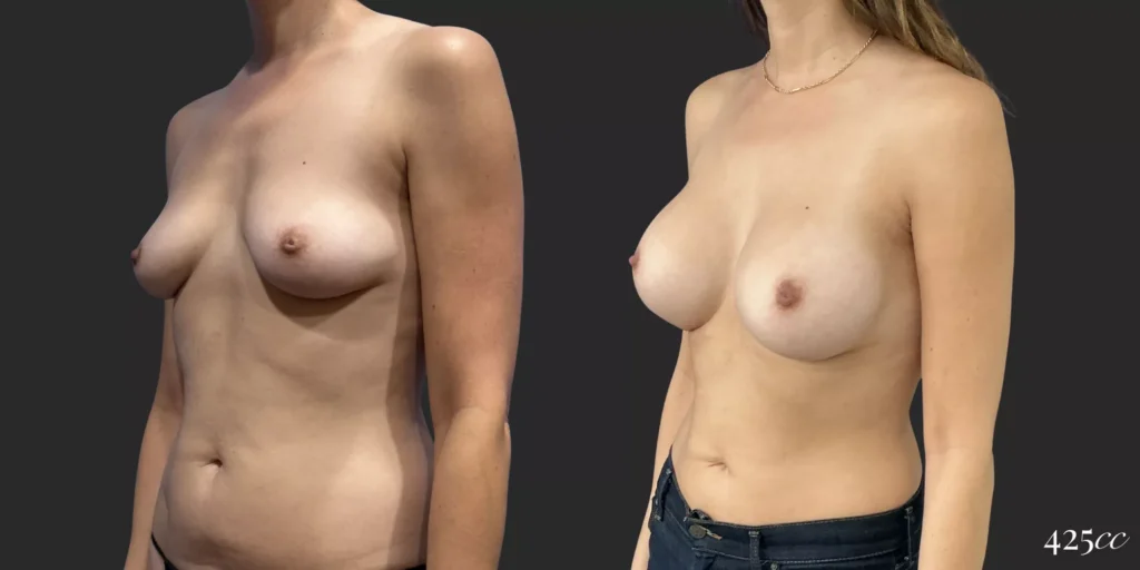 Breast Augmentation #052, before and after photo, view 2