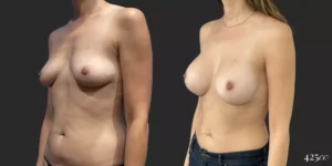 Breast Augmentation #052, before and after photo, view 2