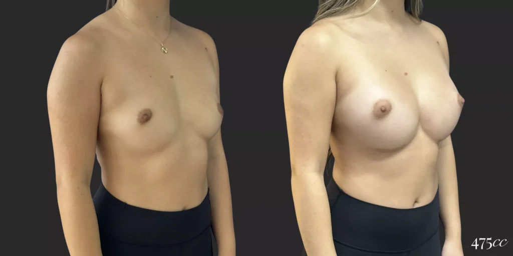Breast Augmentation #055, before and after photo, view 2