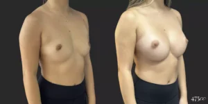 Breast Augmentation #055, before and after photo, view 2