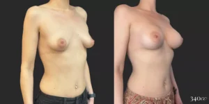 Breast Augmentation #056, before and after photo, view 2