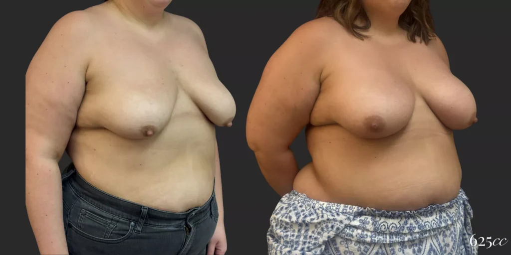 Breast Augmentation #057, before and after photo, view 2