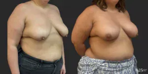 Breast Augmentation #057, before and after photo, view 2