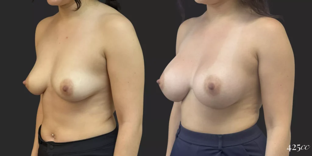 Breast Augmentation #058, before and after photo, view 2