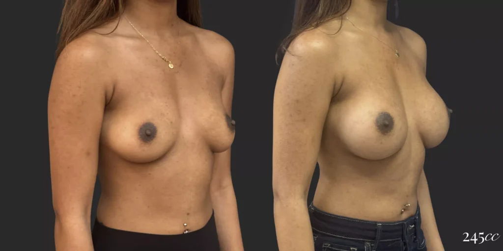 Breast Augmentation #060, before and after photo, view 2
