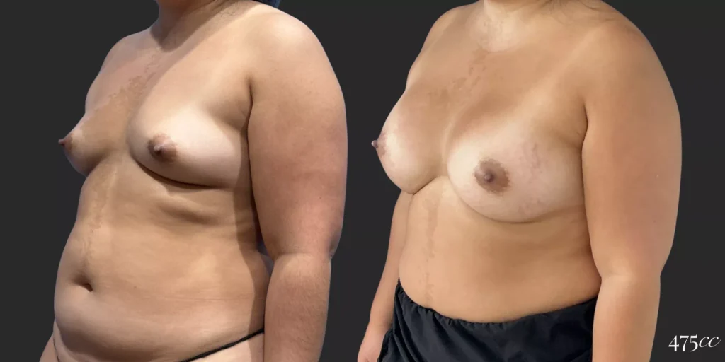 Breast Augmentation #062, before and after photo, view 2