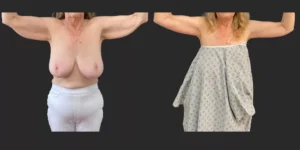 Arm Lift #003, before and after photo, view 2