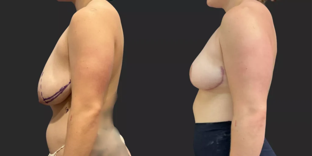 Breast Reduction #001, before and after photo, view 2