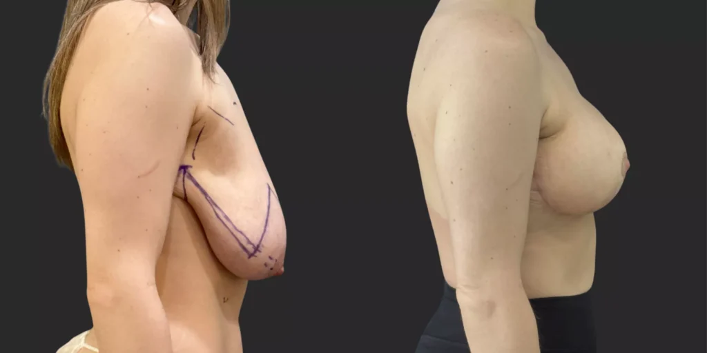 Breast Reduction  #002, before and after photo, view 2