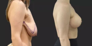 Breast Reduction  #002, before and after photo, view 2