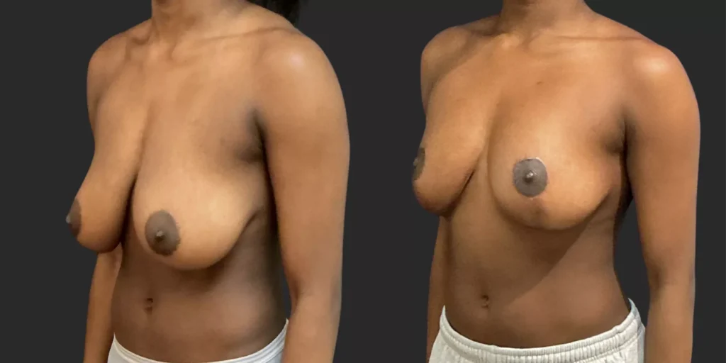 Breast Reduction #003, before and after photo, view 2