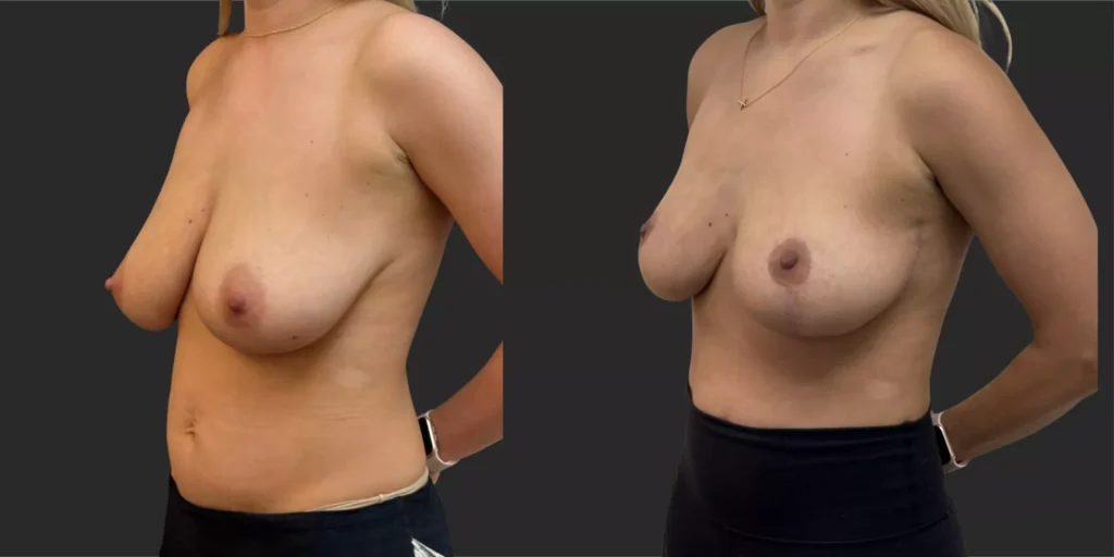 Breast Reduction #004, before and after photo, view 2