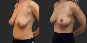 Breast Reduction #004, before and after photo, view 2