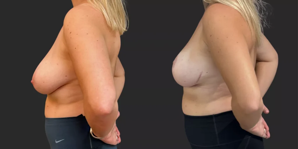 Breast Reduction #005, before and after photo, view 2