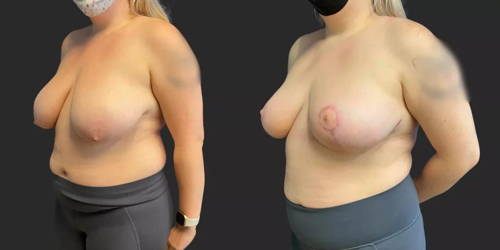 Breast Reduction #007, before and after photo, view 2