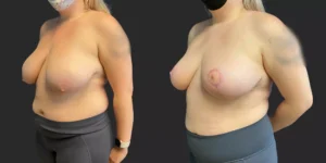 Breast Reduction #007, before and after photo, view 2