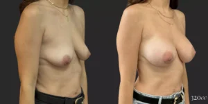 Breast Augmentation #016, before and after photo, view 2
