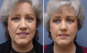 Face Lift #002, before and after photo