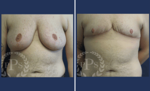 FTM Chest Masculinization Surgery #003, before and after photo