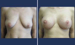 Breast Augmentation + Lift #003, before and after photo
