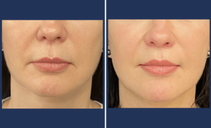 Lip Lift #004, before and after photo