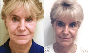 Face Lift #003, before and after photo