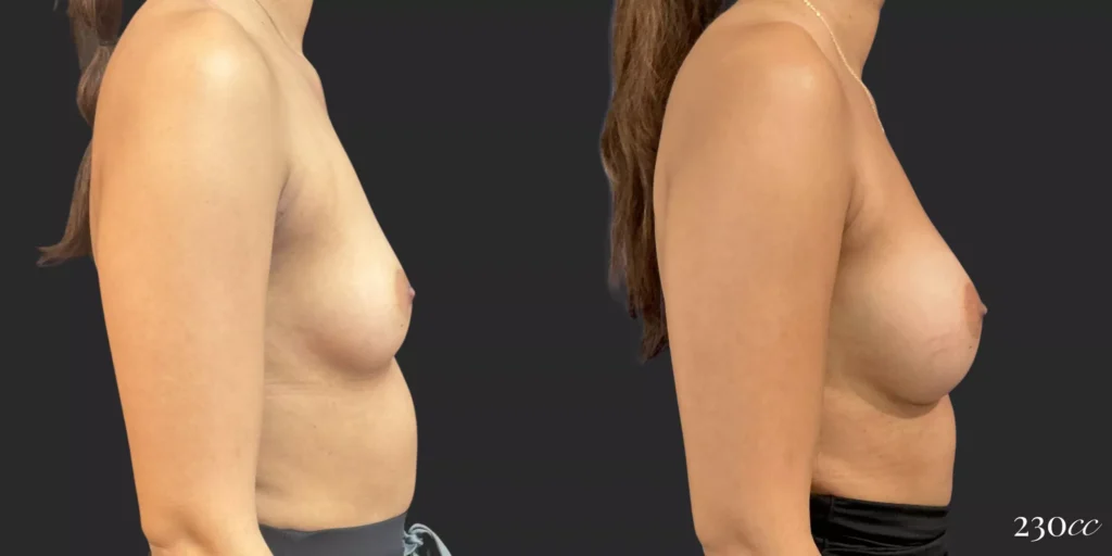 Breast Augmentation #001, before and after photo, view 3