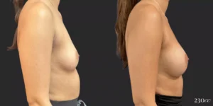 Breast Augmentation #001, before and after photo, view 3