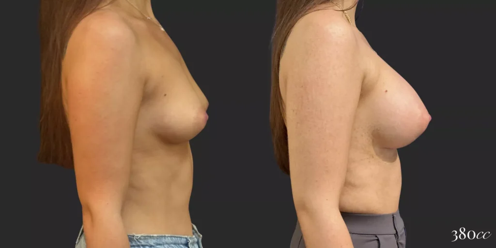 Breast Augmentation #002, before and after photo, view 3