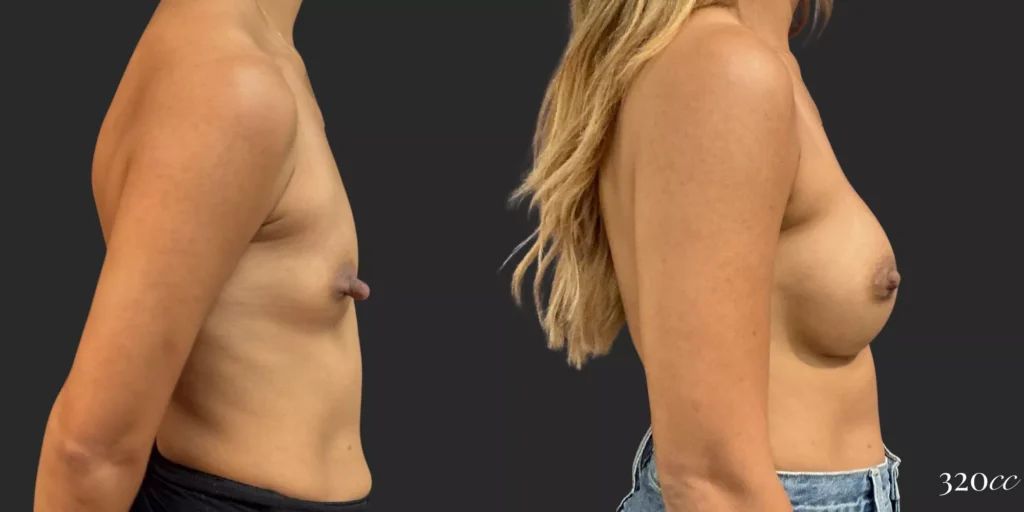 Breast Augmentation #005, before and after photo, view 3