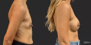 Breast Augmentation #005, before and after photo, view 3