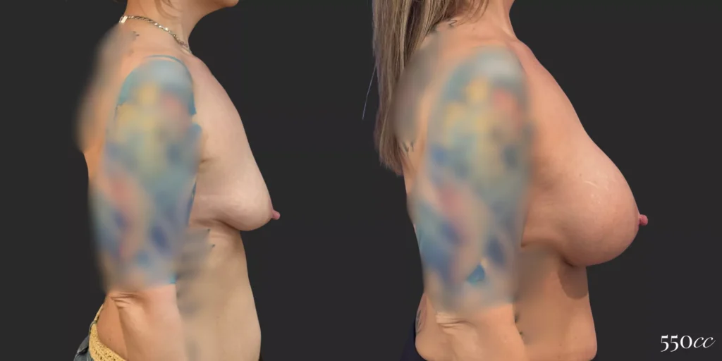 Breast Augmentation #007, before and after photo, view 3