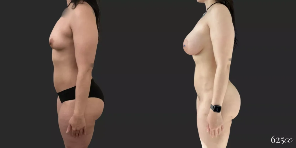 Breast Augmentation with 360 Lipo plus Lipo of Inner/Outer Thighs and Knees #013, before and after photo, view 3