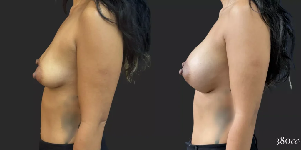 Breast Augmentation #014, before and after photo, view 3